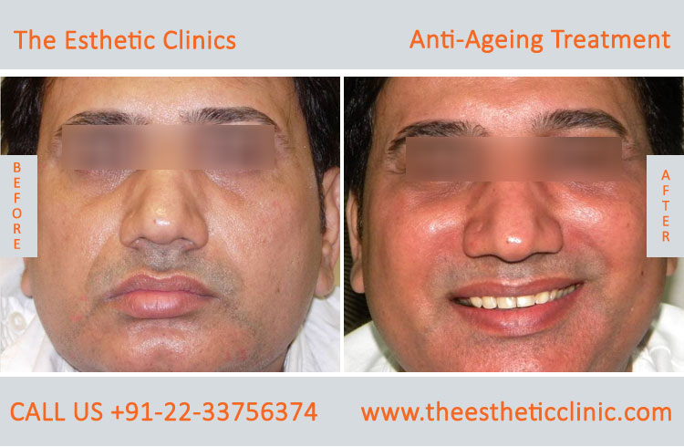 Anti Aging Treatment for Face Wrinkles before after photos in mumbai india (1 (8)